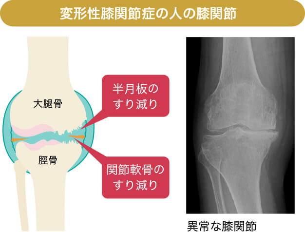 変形性膝関節症の人の膝関節